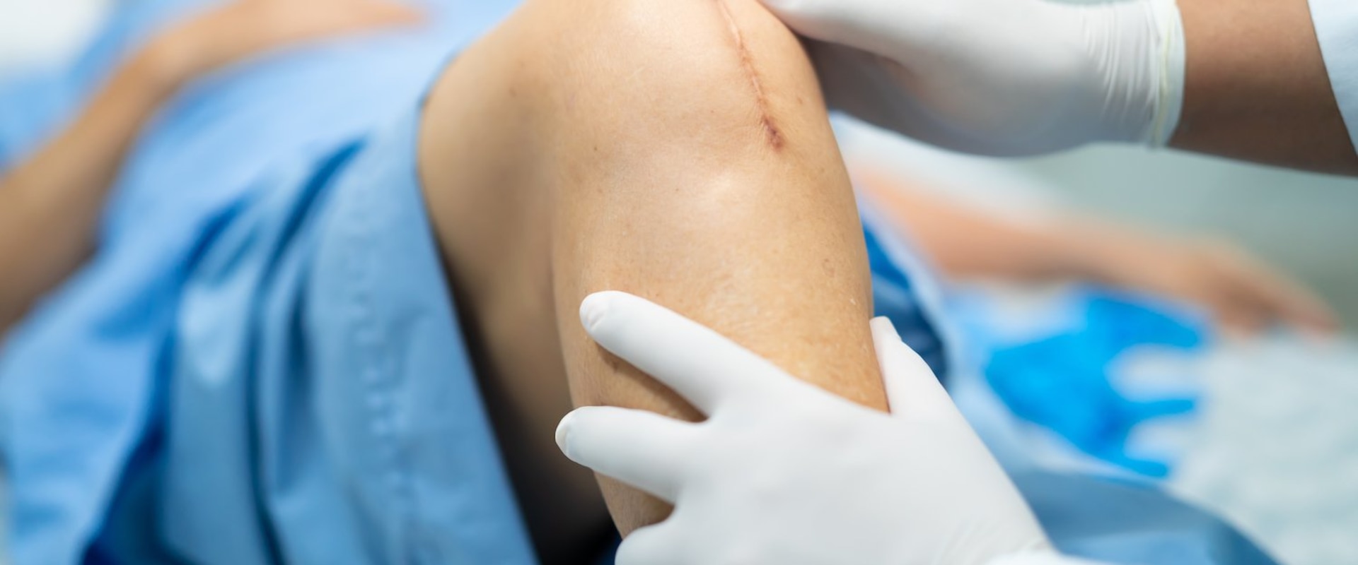 How Long Do Dissolvable Stitches Last? Healing Facts You Need to Know