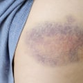Does a Blood Clot Look Like a Bruise on Your Skin? DVT Symptoms, Risks & Prevention