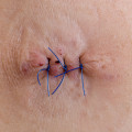 What Do Dissolvable Stitches Look Like? Know What to Expect