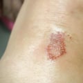 What Does an Infected Cut Look Like? Spot Signs & Act Fast