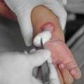 Recognize & Treat Granulation Tissue, Slough in Wounds