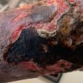 Who Can Perform Wound Debridement?
