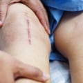 Natural Ways to Heal Surgery Wounds Faster: Holistic Healing Techniques for Quick Recovery