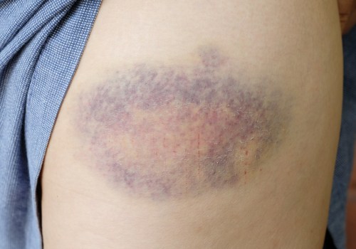 Does a Blood Clot Look Like a Bruise on Your Skin? DVT Symptoms, Risks & Prevention