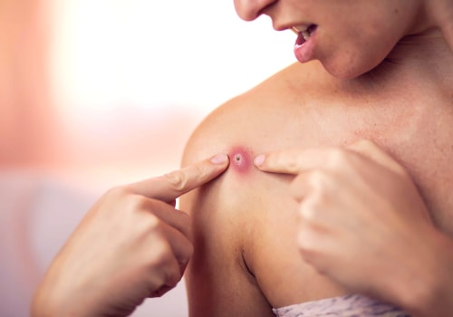 Purulent Wound Drainage Causes & Treatment You Can Trust