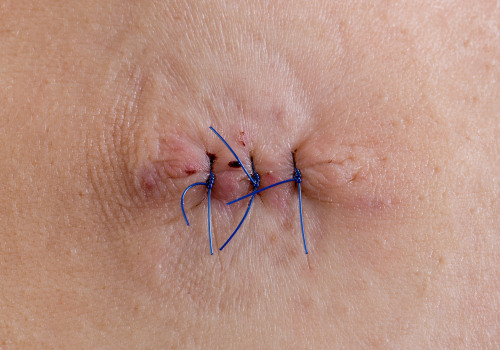 What Do Dissolvable Stitches Look Like? Know What to Expect