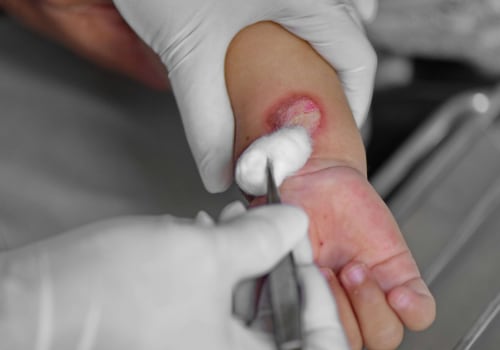 Recognize & Treat Granulation Tissue, Slough in Wounds