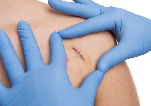 Dissolvable Stitches Healing Stages: How to Heal Faster & Safer
