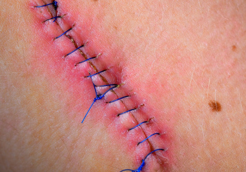 What Do Dissolvable Stitches Healing Stages Look Like? Everything You Should Know to Ensure Proper Healing