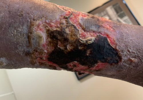 Who Can Perform Wound Debridement?