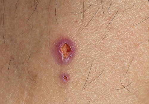 What is Granulation Tissue? And Its Role In Chronic Wound Treatment